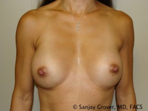 Breast Augmentation Before and After 86 | Sanjay Grover MD FACS