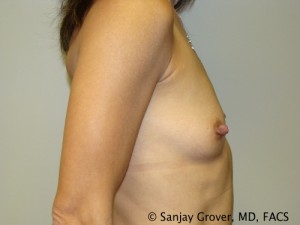 Breast Augmentation Before and After 86 | Grover Aesthetics