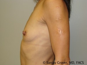 Breast Augmentation Before and After 86 | Grover Aesthetics