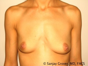 Breast Augmentation Before and After | Grover Aesthetics