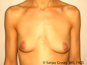 Breast Augmentation Before and After 182 | Sanjay Grover MD FACS