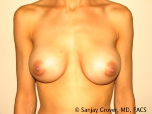 Breast Augmentation Before and After | Sanjay Grover MD FACS