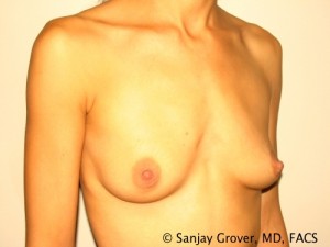 Breast Augmentation Before and After 87 | Sanjay Grover MD FACS