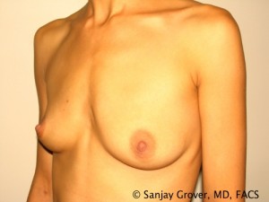 Breast Augmentation Before and After 87 | Grover Aesthetics