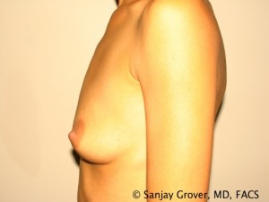 Breast Augmentation Before and After 87 | Grover Aesthetics