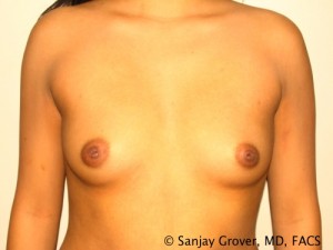 Breast Augmentation Before and After 99 | Sanjay Grover MD FACS