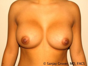 Breast Augmentation Before and After | Grover Aesthetics