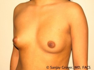 Breast Augmentation Before and After 88 | Grover Aesthetics