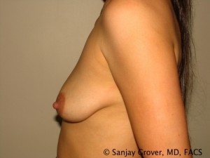 Breast Augmentation Before and After 89 | Grover Aesthetics