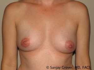 Breast Augmentation Before and After | Grover Aesthetics
