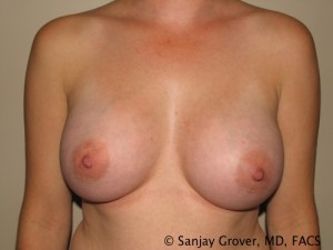 Breast Augmentation Before and After | Grover Aesthetics