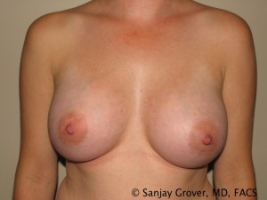 Breast Augmentation Before and After | Sanjay Grover MD FACS