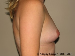 Breast Augmentation Before and After 90 | Grover Aesthetics