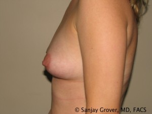 Breast Augmentation Before and After 90 | Grover Aesthetics