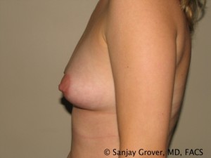 Breast Augmentation Before and After 90 | Sanjay Grover MD FACS