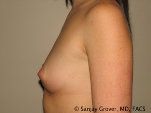 Breast Augmentation Before and After 91 | Sanjay Grover MD FACS