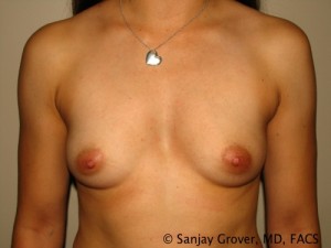 Breast Augmentation Before and After 300 | Sanjay Grover MD FACS