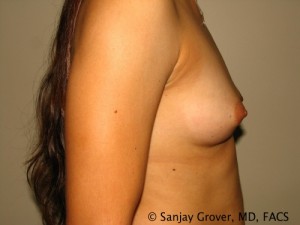 Breast Augmentation Before and After 92 | Grover Aesthetics