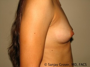 Breast Augmentation Before and After 92 | Sanjay Grover MD FACS