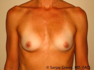 Breast Augmentation Before and After | Grover Aesthetics