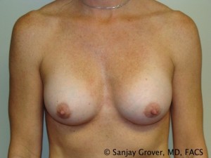 Breast Augmentation Before and After | Grover Aesthetics
