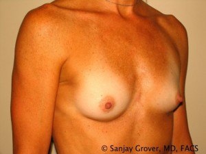 Breast Augmentation Before and After 93 | Sanjay Grover MD FACS