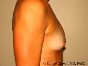 Breast Augmentation Before and After 93 | Grover Aesthetics