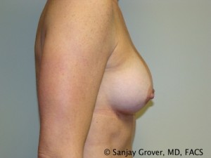 Breast Augmentation Before and After 93 | Grover Aesthetics