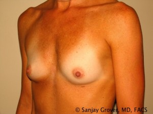 Breast Augmentation Before and After 93 | Sanjay Grover MD FACS