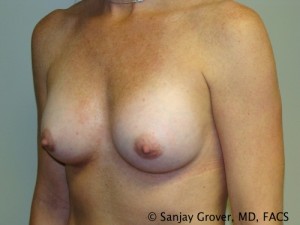 Breast Augmentation Before and After 93 | Sanjay Grover MD FACS