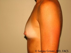 Breast Augmentation Before and After 93 | Grover Aesthetics