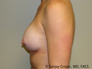 Breast Augmentation Before and After 93 | Grover Aesthetics