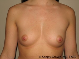 Breast Augmentation Before and After 108 | Sanjay Grover MD FACS