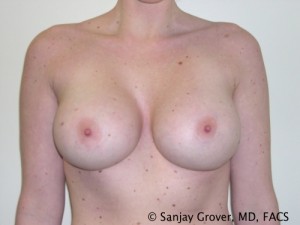 Breast Augmentation Before and After 94 | Sanjay Grover MD FACS