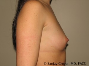 Breast Augmentation Before and After 94 | Grover Aesthetics
