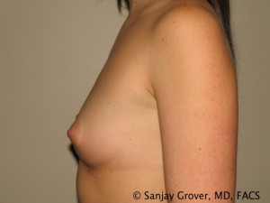 Breast Augmentation Before and After 94 | Grover Aesthetics