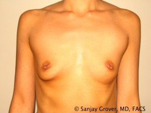 Breast Augmentation Before and After 191 | Sanjay Grover MD FACS