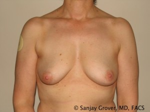 Breast Augmentation Before and After | Grover Aesthetics