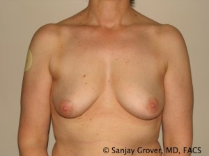 Breast Augmentation Before and After 75 | Sanjay Grover MD FACS