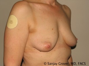 Breast Augmentation Before and After 95 | Grover Aesthetics