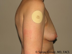 Breast Augmentation Before and After 95 | Grover Aesthetics