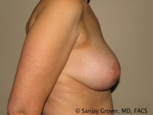 Breast Augmentation Before and After 95 | Grover Aesthetics