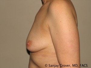 Breast Augmentation Before and After 95 | Grover Aesthetics