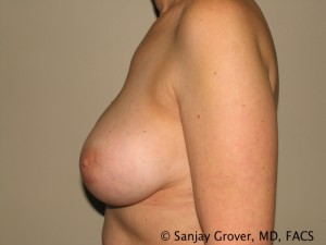 Breast Augmentation Before and After 95 | Grover Aesthetics