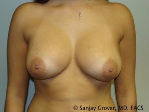 Breast Augmentation Before and After | Sanjay Grover MD FACS