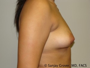 Breast Augmentation Before and After 96 | Grover Aesthetics