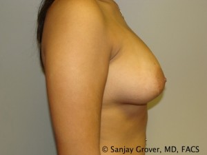 Breast Augmentation Before and After 96 | Grover Aesthetics
