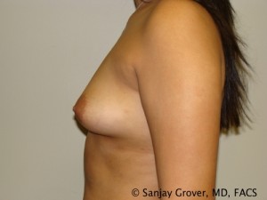 Breast Augmentation Before and After 96 | Grover Aesthetics
