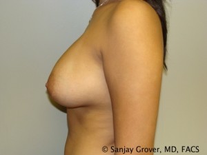 Breast Augmentation Before and After 96 | Sanjay Grover MD FACS