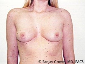 Breast Augmentation Before and After | Grover Aesthetics